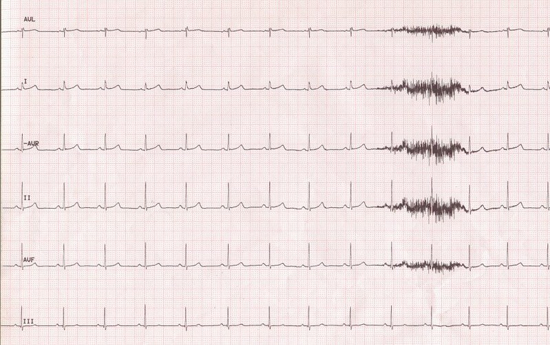 EKG (Electrocardiogram)