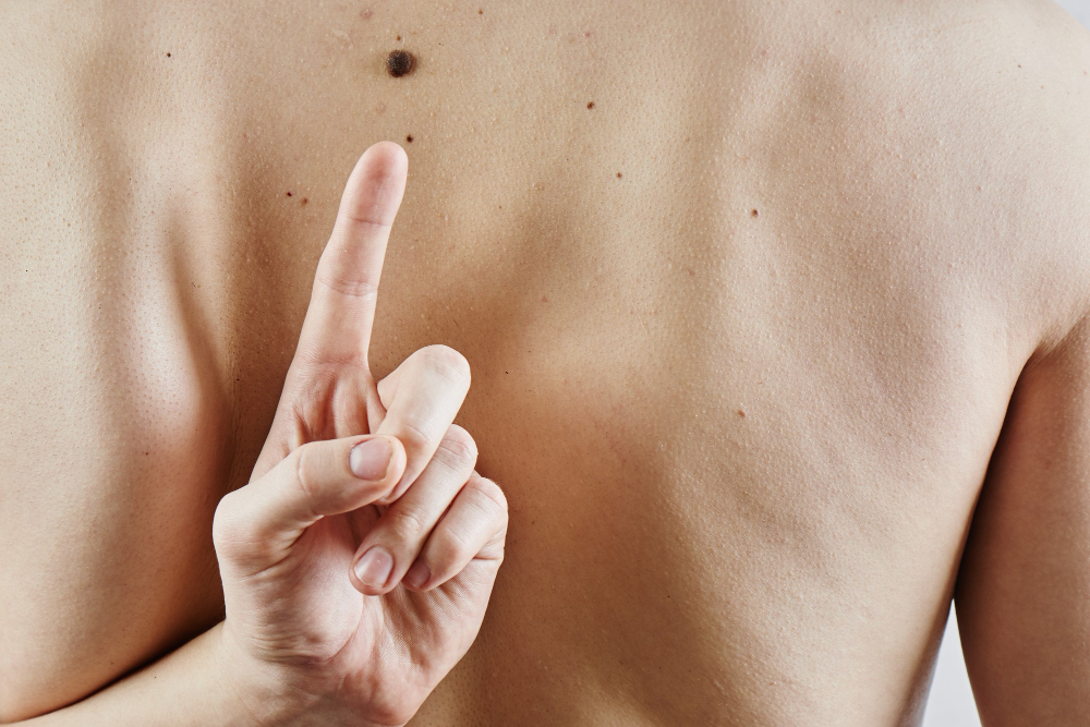 Mole and Skin Lesion Removal